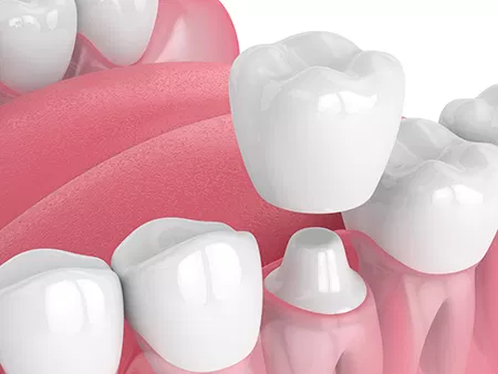 Ceramic Dental Crowns